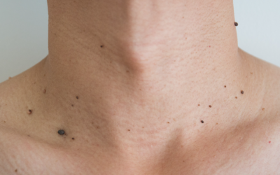 VERRUGAS, MANCHAS MARRONES, PAPIOMA Y ACNÉ ¿ES SOLO UN TRASTORNO DE PIEL?