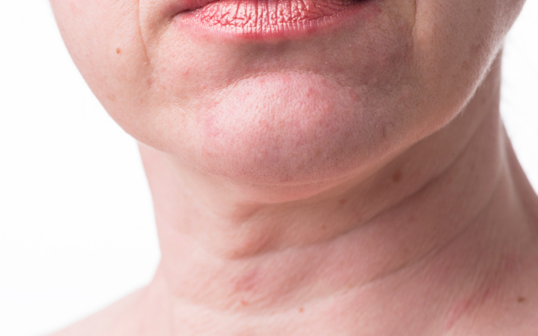 EVITAR Y MEJORAR LAS ARRUGAS DEL CUELLO